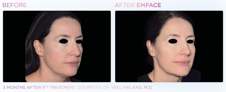 Emface_before-after-1
