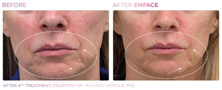 Emface_before-after-5