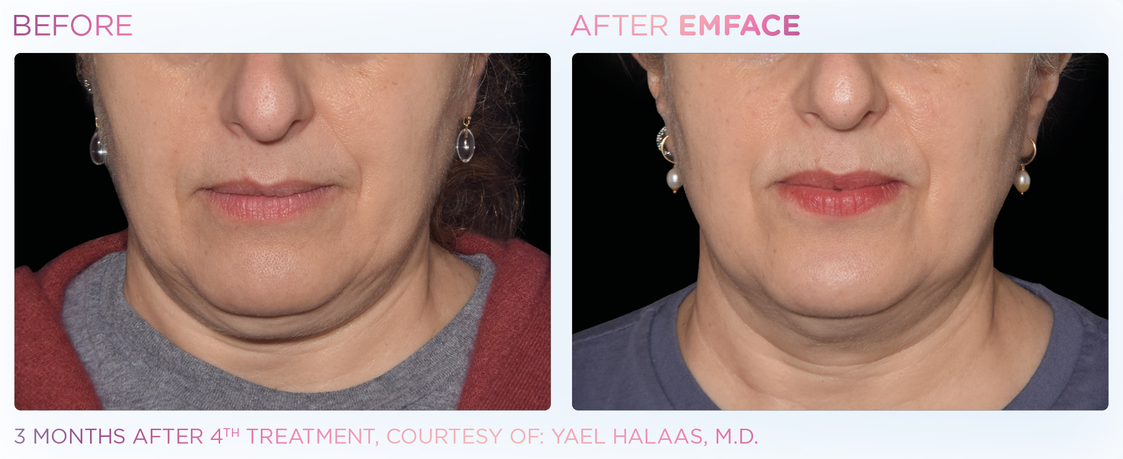 Emface_before-after-6