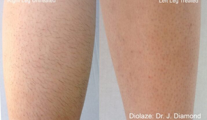 diolazexl-before-after-dr-j-diamond-preview-3