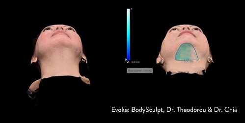 evoke-before-after-bodysculpt-dr-theodorou-dr-chia-preview-2