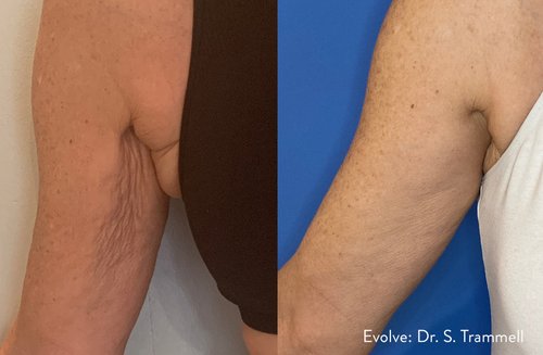 evolve-before-after-dr-s-trammel-preview-1