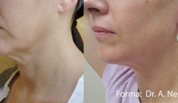 forma-before-after-dr-a-nelson-preview-1