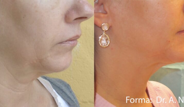 forma-before-after-dr-a-nelson-preview-2