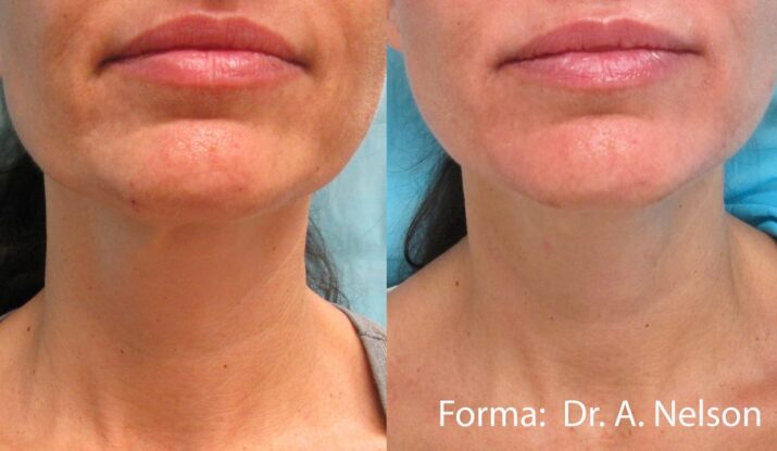 forma-before-after-dr-a-nelson-preview-4