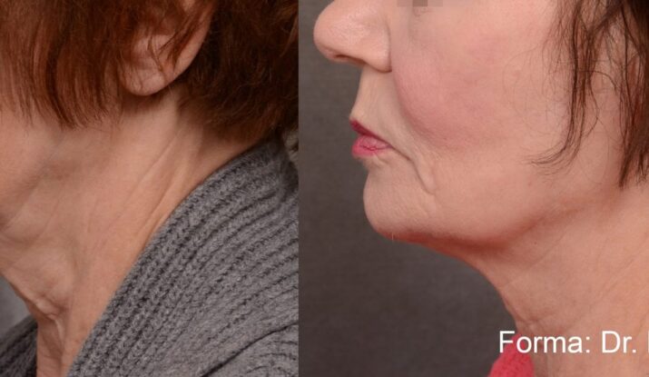 forma-before-after-dr-b-ridenour-preview-1