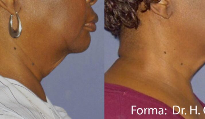 forma-before-after-dr-h-ohanian-preview-1
