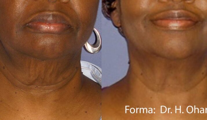 forma-before-after-dr-h-ohanian-preview-3