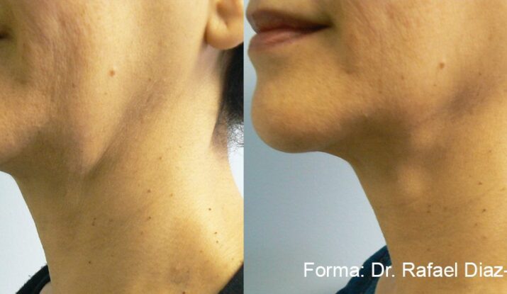 forma-before-after-dr-r-diaz-yoserev-preview-1