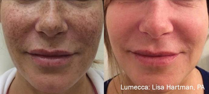 lumecca-before-after-dr-l-hartman-preview-2