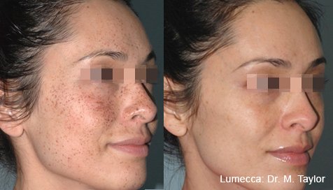 lumecca-before-after-dr-m-taylor-preview-4