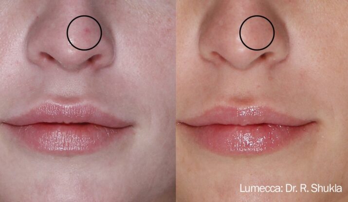 lumecca-before-after-dr-r-shukla-preview-1