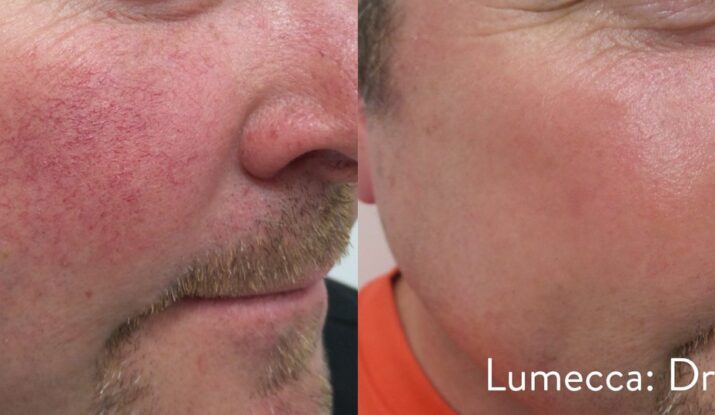 lumecca-before-after-dr-r-shukla-preview-5
