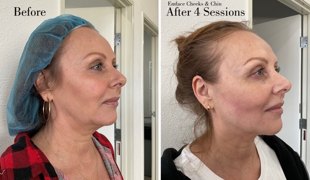 Emface Cheeks and Chin